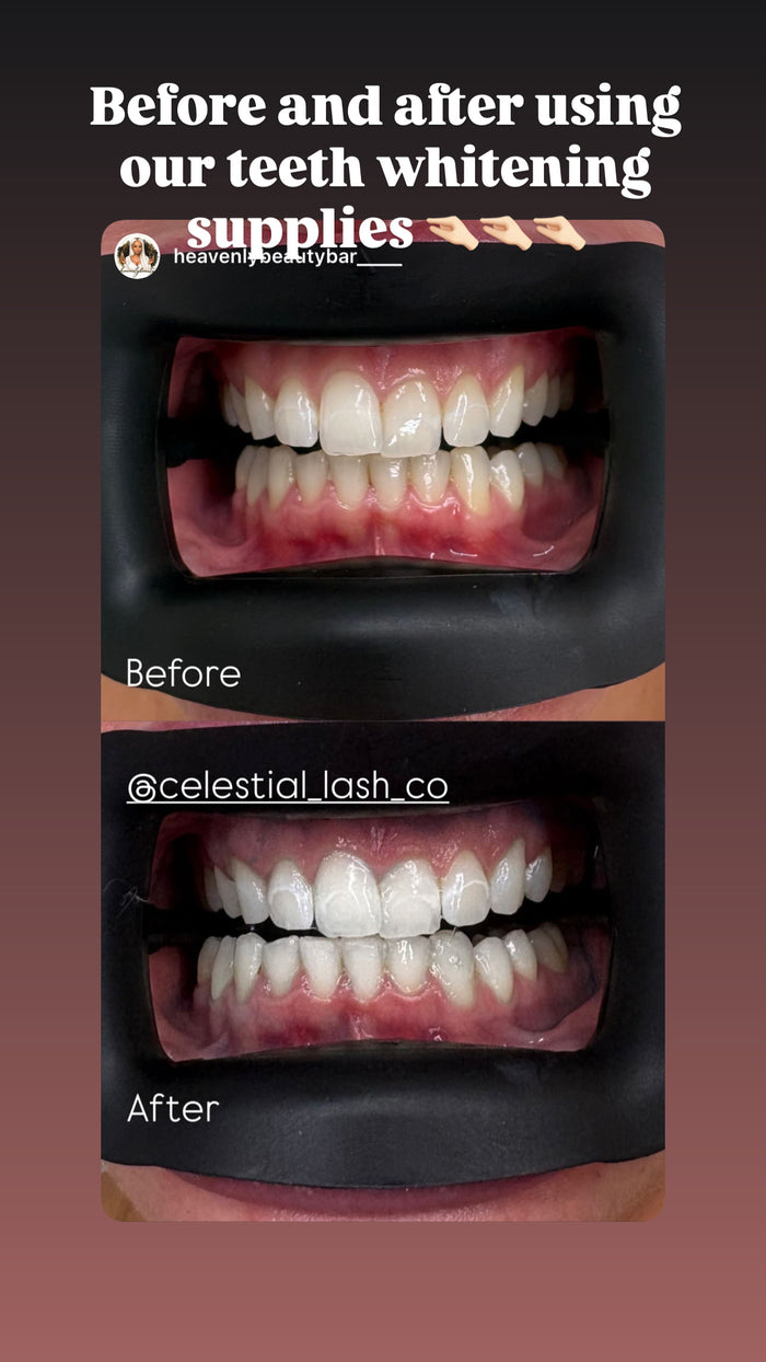 CLC Teeth Whitening Kit